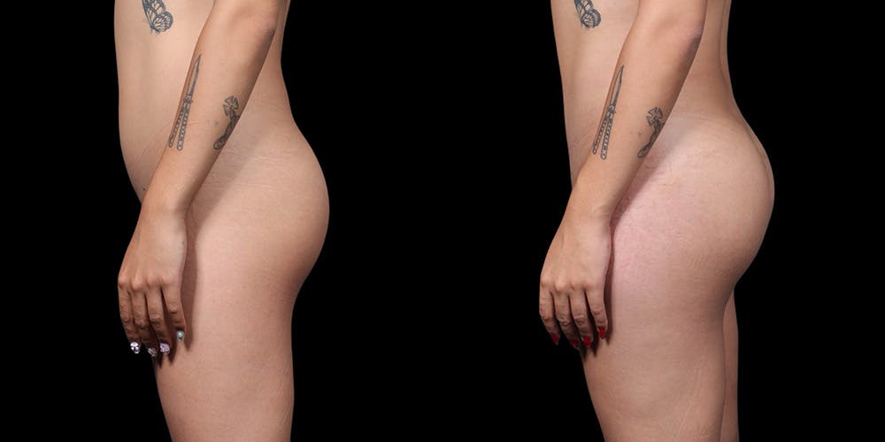 Transgender Body Contouring Before & After Gallery - Patient 821003 - Image 3