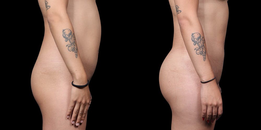 Transgender Body Contouring Before & After Gallery - Patient 821003 - Image 2