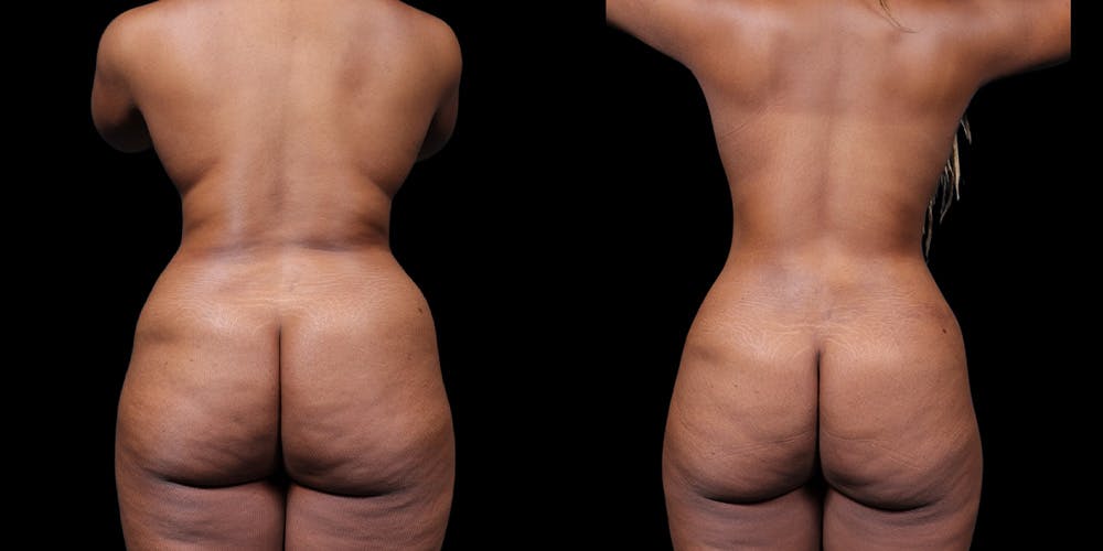 HiDefinition Liposuction Before & After Gallery - Patient 38299008 - Image 4