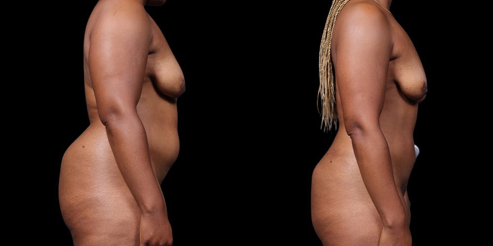 HiDefinition Liposuction Before & After Gallery - Patient 38299008 - Image 3