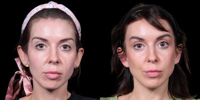 Facelift Before & After Gallery - Patient 376385 - Image 1