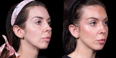 Facelift Before & After Gallery - Patient 376385 - Image 2
