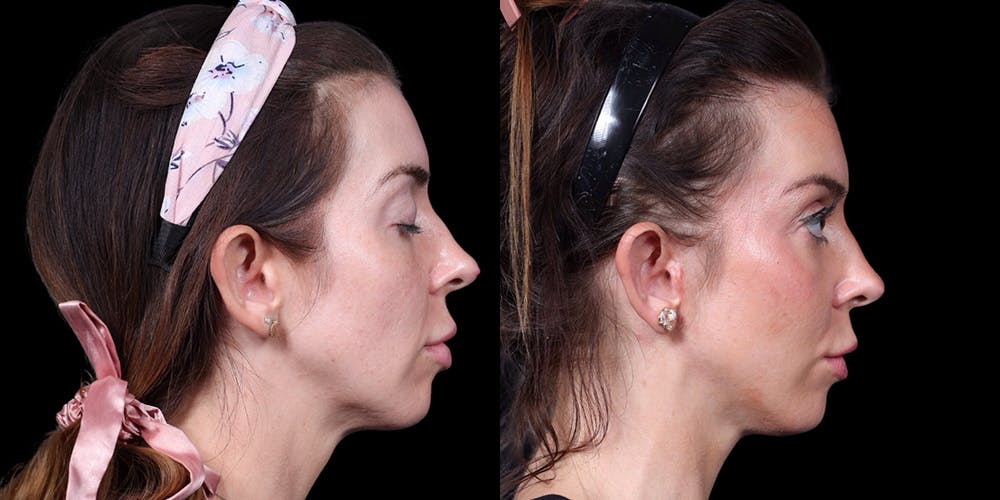 Facelift Before & After Gallery - Patient 376385 - Image 3