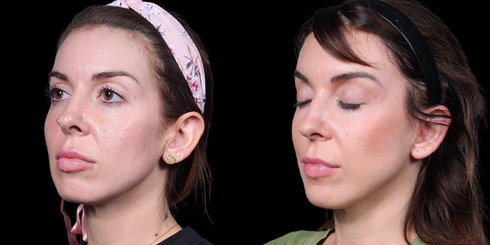 Facelift Before & After Gallery - Patient 376385 - Image 4