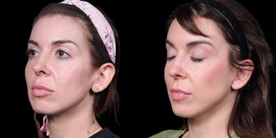 Facelift Before & After Gallery - Patient 376385 - Image 4