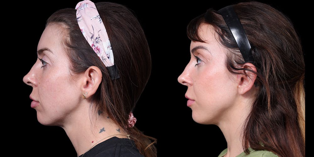 Facelift Before & After Gallery - Patient 376385 - Image 5