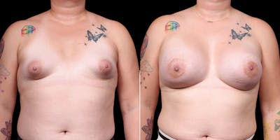 MTF Top Surgery Before & After Gallery - Patient 142835 - Image 1