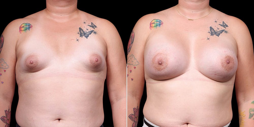 MTF Top Surgery Before & After Gallery - Patient 142835 - Image 1