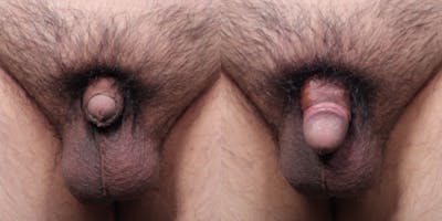 Penis Enhancement Before & After Gallery - Patient 324855 - Image 1