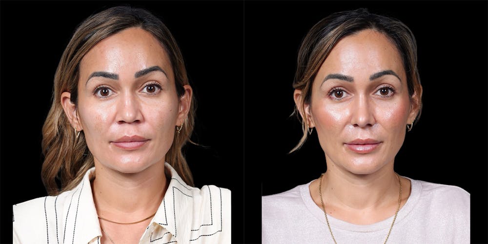 Asian Rhinoplasty Before & After Gallery - Patient 416958 - Image 3