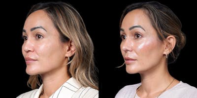 Asian Rhinoplasty Before & After Gallery - Patient 416958 - Image 2