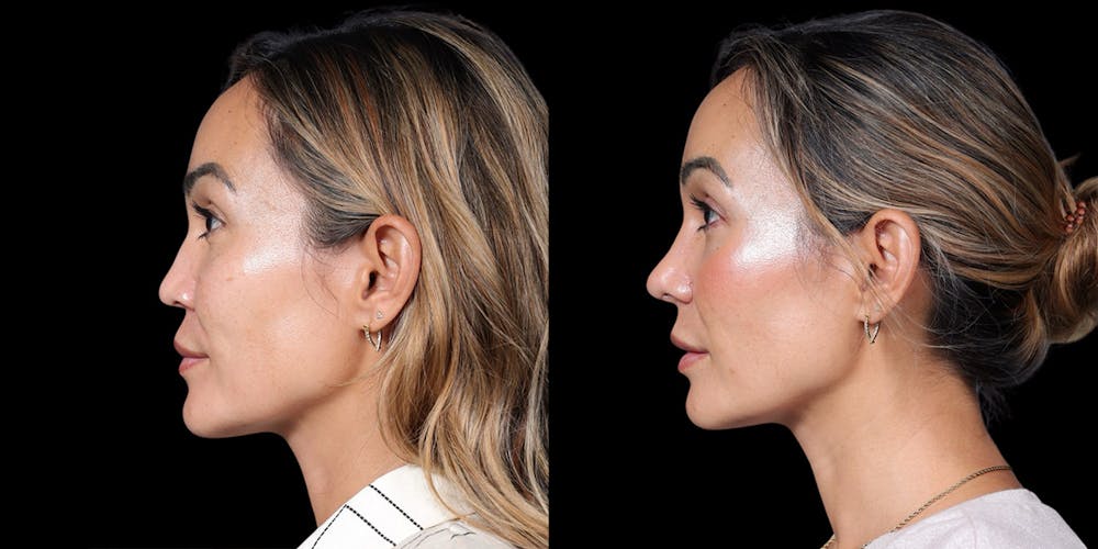 Asian Rhinoplasty Before & After Gallery - Patient 416958 - Image 1
