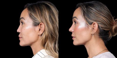 Asian Rhinoplasty Before & After Gallery - Patient 416958 - Image 1