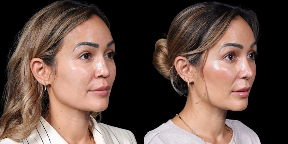 Asian Rhinoplasty Before & After Gallery - Patient 416958 - Image 4
