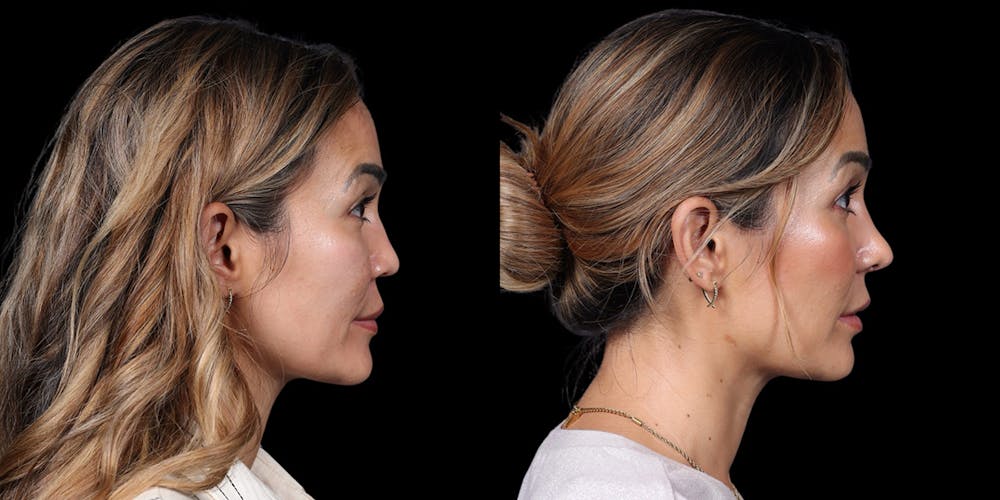 Asian Rhinoplasty Before & After Gallery - Patient 416958 - Image 5