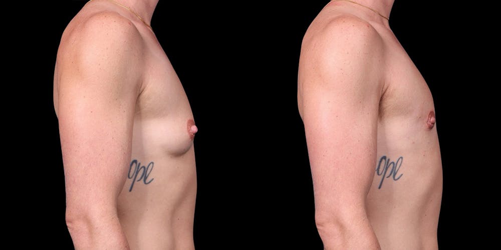 FTM Top Surgery Before & After Gallery - Patient 175771 - Image 3