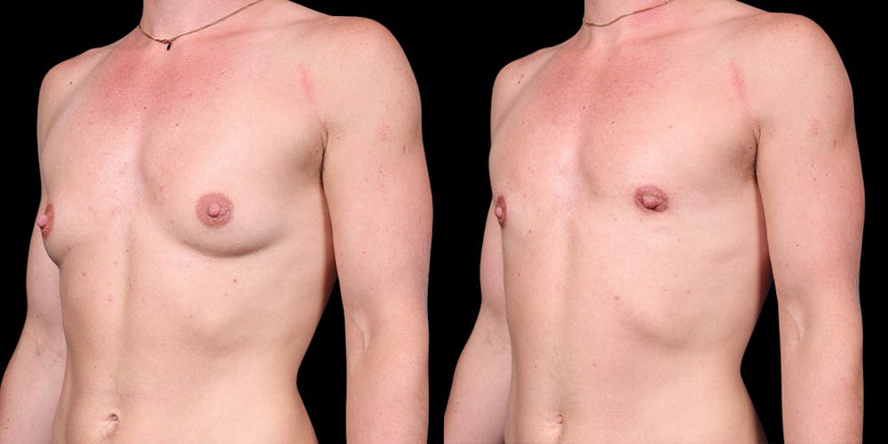 FTM Top Surgery Before & After Gallery - Patient 175771 - Image 4
