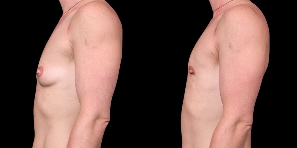 FTM Top Surgery Before & After Gallery - Patient 175771 - Image 5