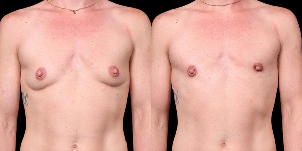 FTM Top Surgery Before & After Gallery - Patient 175771 - Image 1