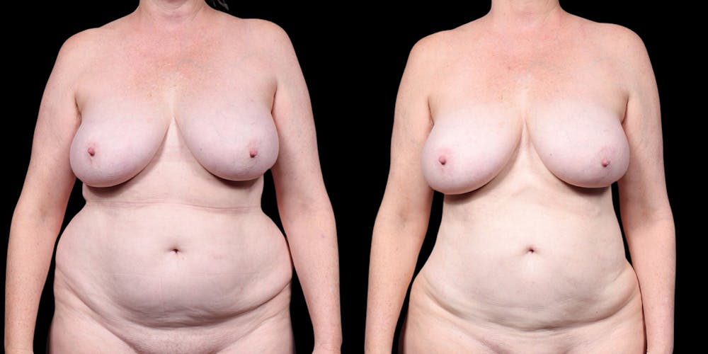 Laser Liposuction Before & After Gallery - Patient 226913 - Image 1