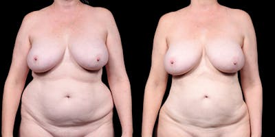 Laser Liposuction Before & After Gallery - Patient 226913 - Image 1
