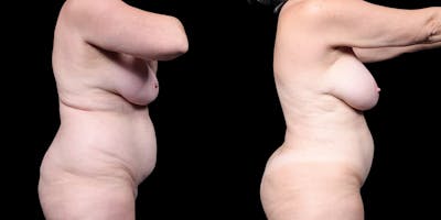 Laser Liposuction Before & After Gallery - Patient 226913 - Image 4