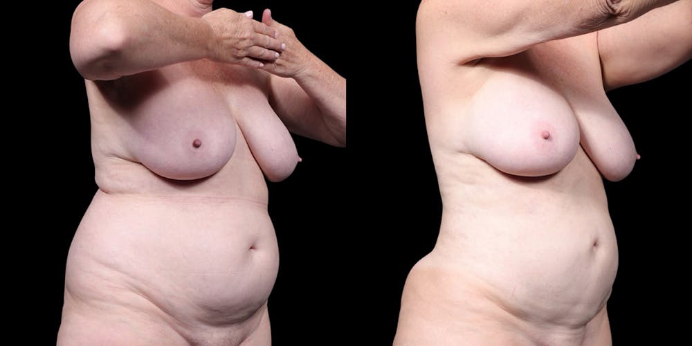 Laser Liposuction Before & After Gallery - Patient 226913 - Image 3