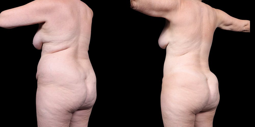 Laser Liposuction Before & After Gallery - Patient 226913 - Image 6