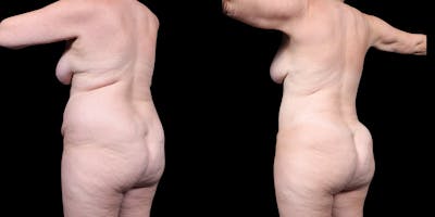 Laser Liposuction Before & After Gallery - Patient 226913 - Image 6