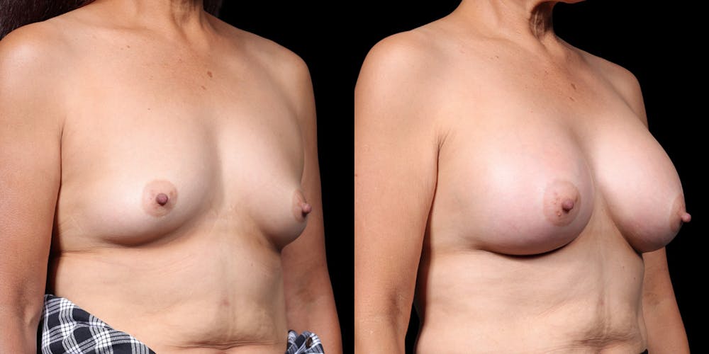 Breast Augmentation Before & After Gallery - Patient 164531 - Image 2