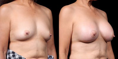 Breast Augmentation Before & After Gallery - Patient 164531 - Image 2