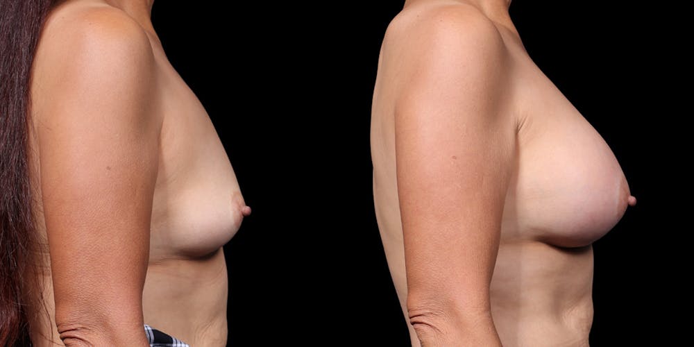 Breast Augmentation Before & After Gallery - Patient 164531 - Image 3