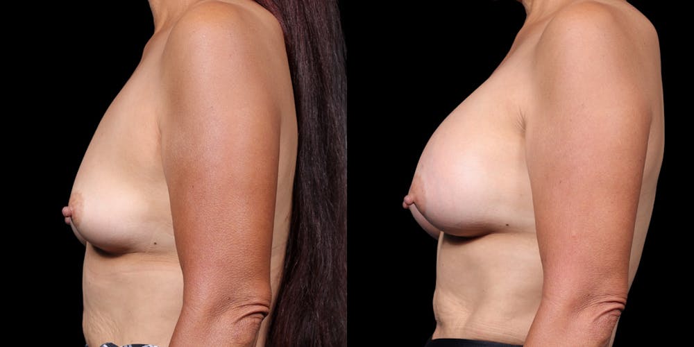 Breast Augmentation Before & After Gallery - Patient 164531 - Image 5