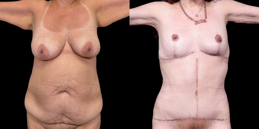 Mommy Makeover Before & After Gallery - Patient 189584 - Image 2