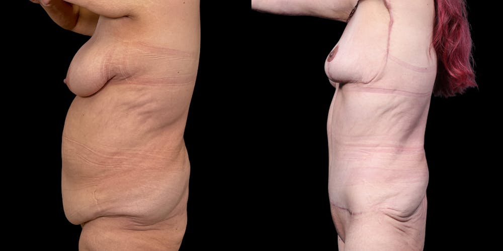 Mommy Makeover Before & After Gallery - Patient 189584 - Image 4