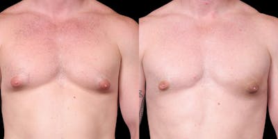 Gynecomastia Before & After Gallery - Patient 121439322 - Image 1