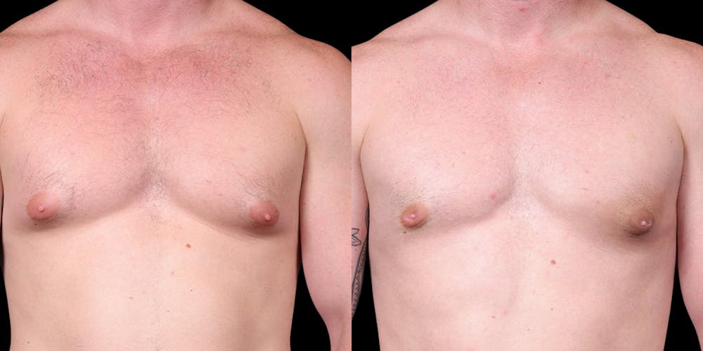 Gynecomastia Before & After Gallery - Patient 121439322 - Image 1