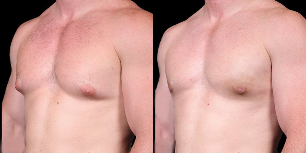 Gynecomastia Before & After Gallery - Patient 121439322 - Image 4