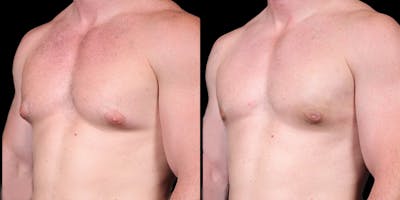 Gynecomastia Before & After Gallery - Patient 121439322 - Image 4