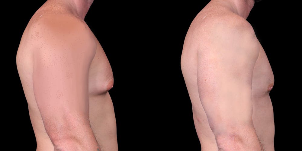 Gynecomastia Before & After Gallery - Patient 121439322 - Image 3