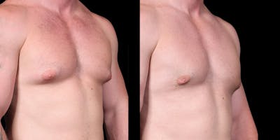 Gynecomastia Before & After Gallery - Patient 121439322 - Image 2