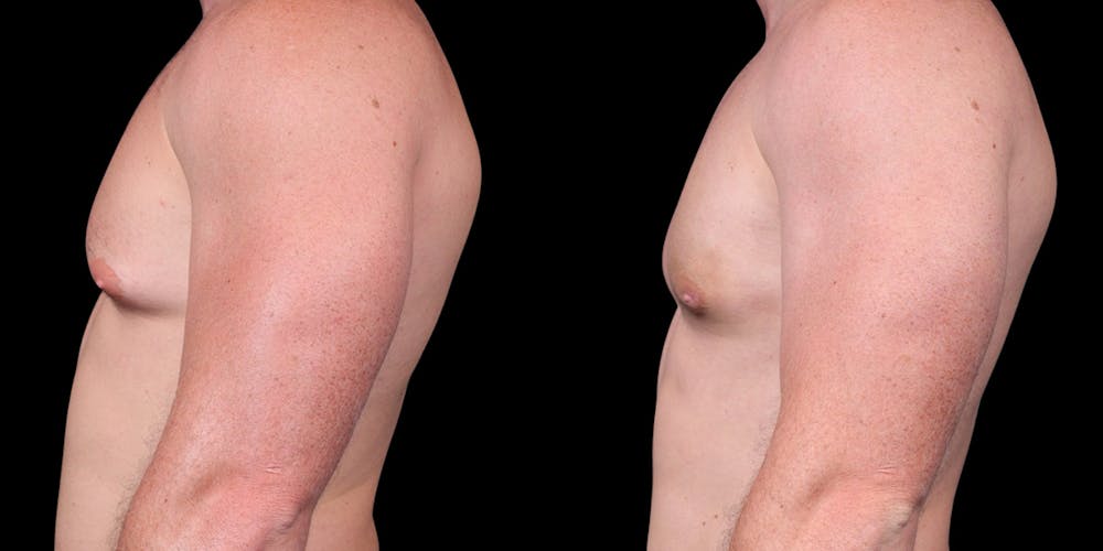 Gynecomastia Before & After Gallery - Patient 121439322 - Image 5