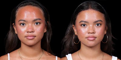 Hairline Advancement Before & After Gallery - Patient 143020141 - Image 1