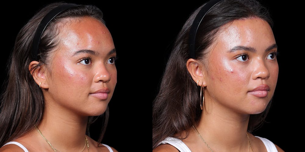 Hairline Advancement Before & After Gallery - Patient 143020141 - Image 2