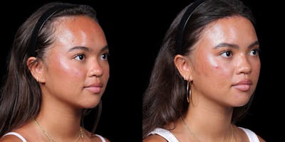 Hairline Advancement Before & After Gallery - Patient 143020141 - Image 2