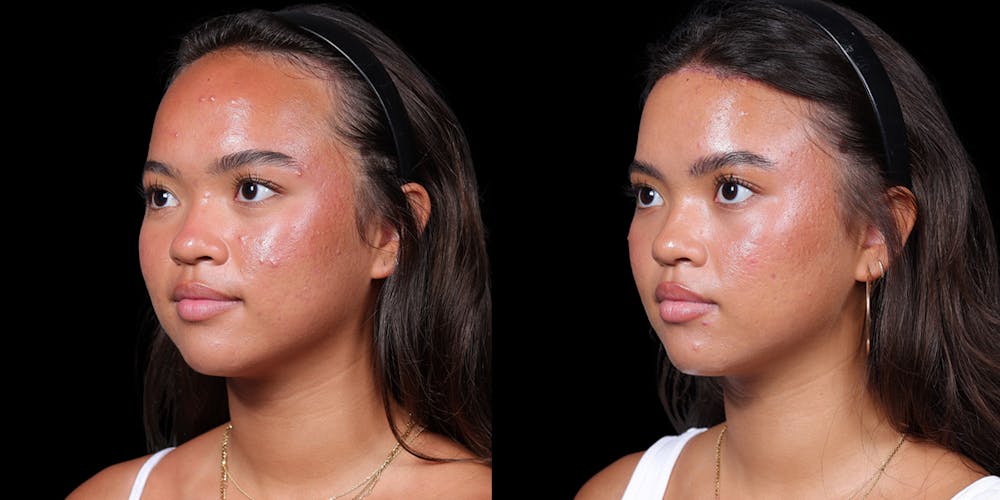 Hairline Advancement Before & After Gallery - Patient 143020141 - Image 4