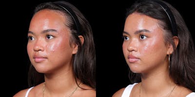 Hairline Advancement Before & After Gallery - Patient 143020141 - Image 4