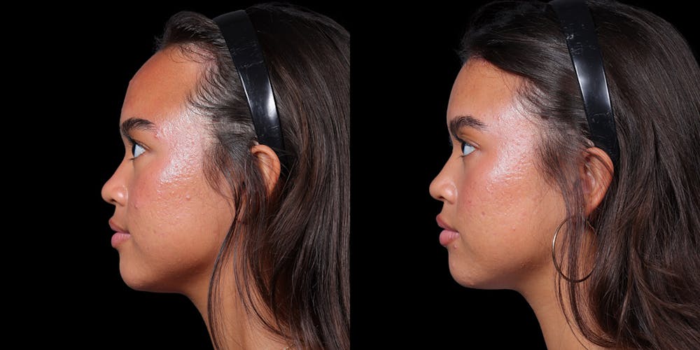 Hairline Advancement Before & After Gallery - Patient 143020141 - Image 5