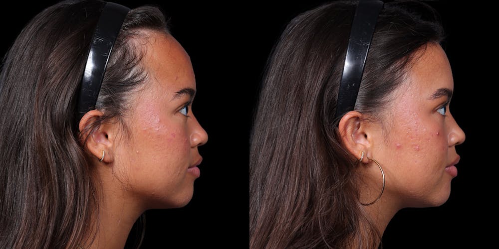 Hairline Advancement Before & After Gallery - Patient 143020141 - Image 3