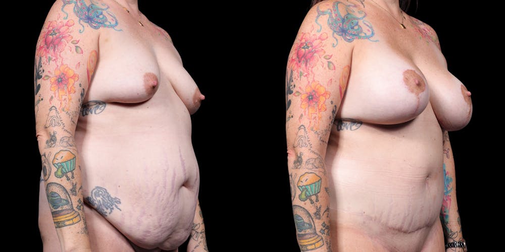 Mommy Makeover Before & After Gallery - Patient 505043 - Image 2